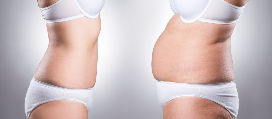 Por que o emagrecimento rápido não é indicado em um pré-operatório de Cirurgia Plástica?